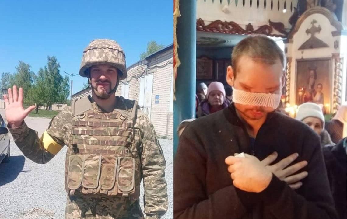 Тато казав, якби був вибір, то краще бути без рук, чим без очей, – військовий з Коростеня, якому реконструюють обличчя