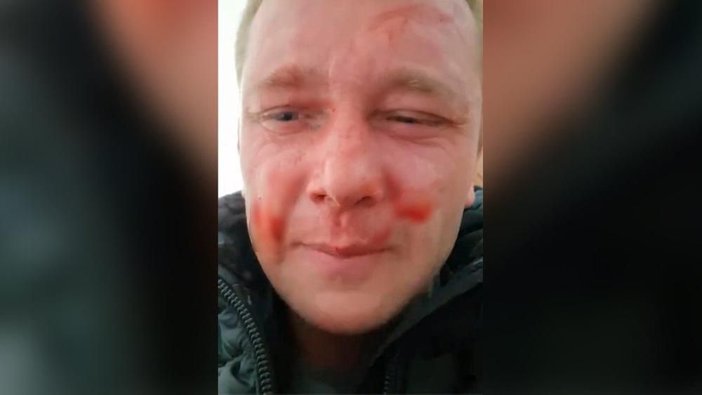 Житель Житомирщини каже, що його вдарили в ТЦК: у Центрі комплектування переконують – маніпуляція