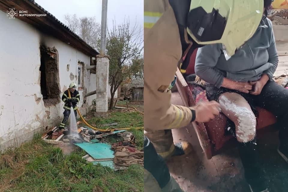 На Овруччині під час пожежі травмувалася 54-річна жінка