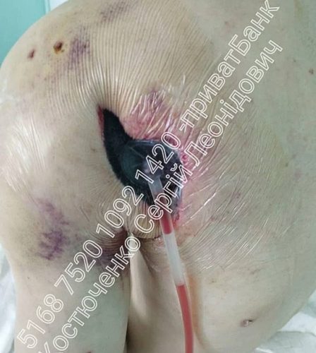 Військовому з Коростеня, якому ампутували руку, потрібна фінансова підтримка (ФОТО 18+)