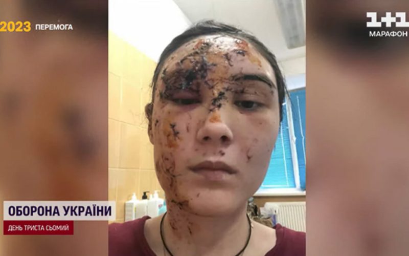 Близько 50 хірургів об’єднались, щоб прибирати з тіл українців шрами війни: оперували й жінку, яка отримала поранення на блокпосту біля Коростеня