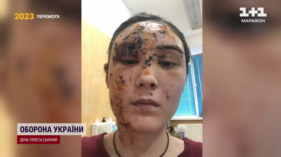 Близько 50 хірургів об’єднались, щоб прибирати з тіл українців шрами війни: оперували й жінку, яка отримала поранення на блокпосту біля Коростеня